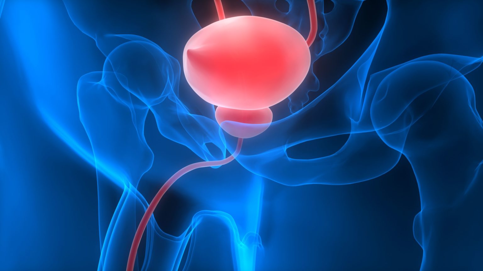 Carcinome V Sical Centre D Hyperthermie De Hanovre